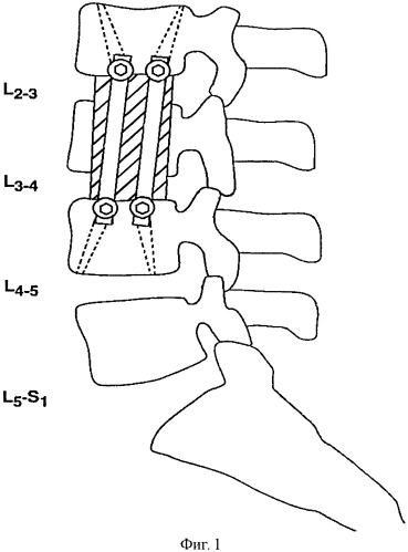 Способ остеосинтеза позвоночника при травмах и заболеваниях (патент 2559275)