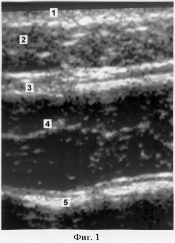 Способ ультразвукового исследования рубцового склероза мышц передней брюшной стенки (патент 2267292)