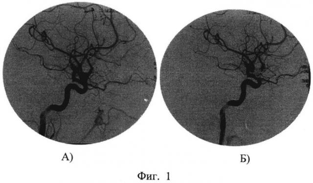 Способ диагностики функционального значения внутренней сонной артерии (патент 2529379)
