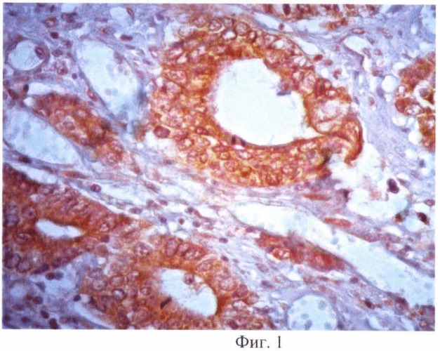 Способ прогнозирования гематогенного метастазирования при кишечном типе рака желудка (патент 2470308)
