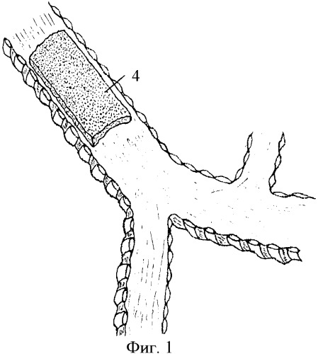 Способ хирургического лечения экспираторного стеноза трахеи и главных бронхов (патент 2376949)