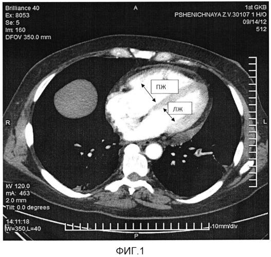 Способ ведения пациентов при тромбоэмболии легочной артерии (патент 2526469)