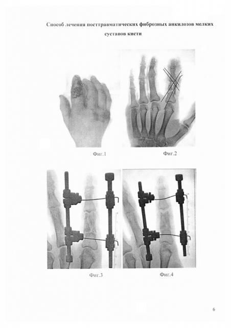 Способ лечения посттравматических фиброзных анкилозов мелких суставов кисти (патент 2626591)