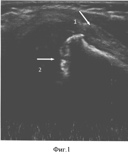Способ ультразвуковой диагностики острого гематогенного метаэпифизарного остеомиелита у детей грудного возраста (патент 2503413)