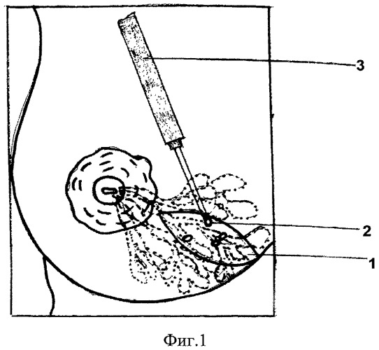 Способ лечения острого гнойного лактационного мастита (патент 2471434)