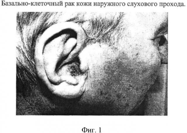 Способ пластики наружного слухового прохода (патент 2419404)
