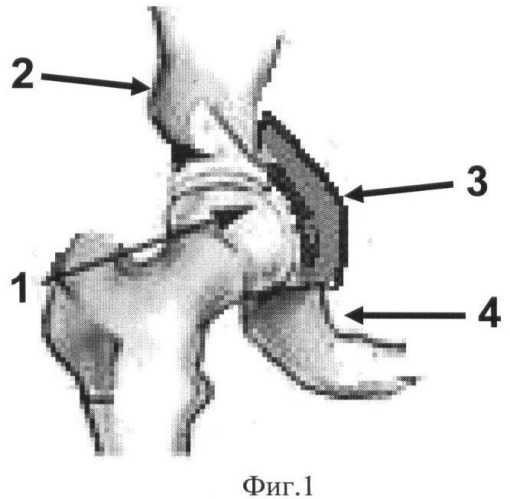 Способ реконструкции дефекта вертлужной впадины (патент 2422109)