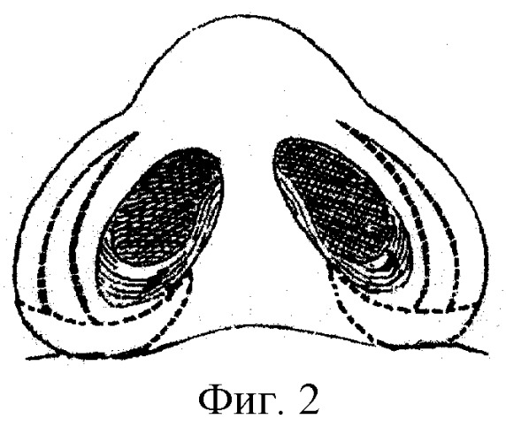 Способ коррекции основания и крыльев носа (патент 2251979)