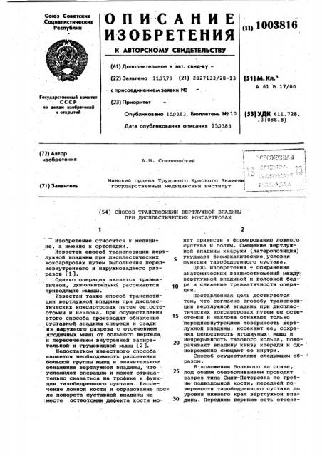 Способ транспозиции вертлужной впадины при диспластических коксартрозах (патент 1003816)