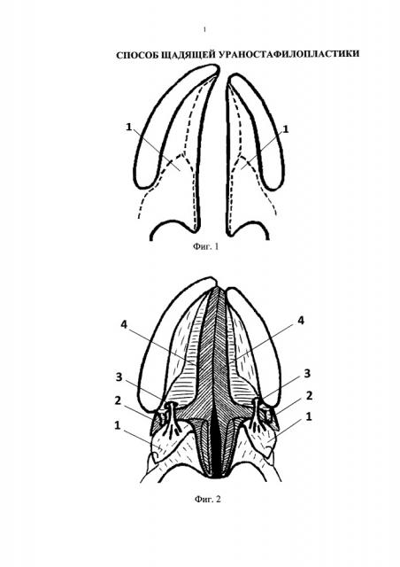 Способ щадящей ураностафилопластики (патент 2651078)