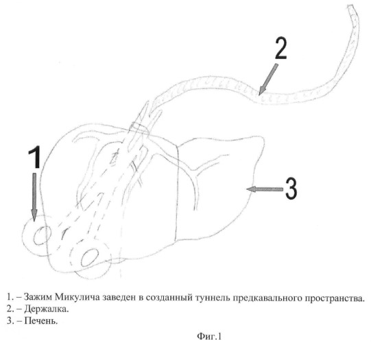 Способ левосторонней гемигепатэктомии (патент 2464941)