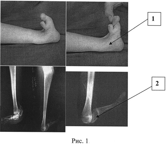 Способ устранения пяточной деформации однолучевой стопы при продольной эктромелии костей голени (патент 2539628)