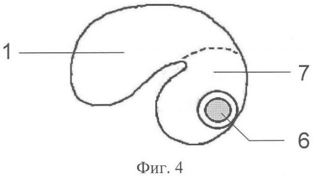 Способ профилактики фиброзной облитерации барабанной полости после консервативно-щадящей радикальной операции с тимпанопластикой (патент 2350305)