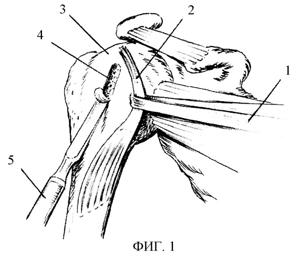 Способ хирургического лечения привычного вывиха плеча (патент 2392895)