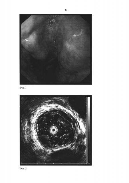 Способ эндоскопического склерозирования варикозно-расширенных вен пищевода и желудка (патент 2601861)
