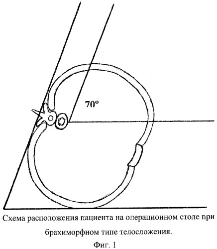 Способ лечения заболеваний пищевода (патент 2269941)