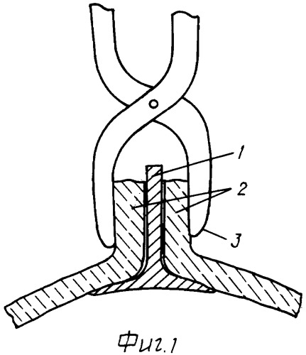 Способ наложения разъемной гипсовой повязки (патент 2336063)