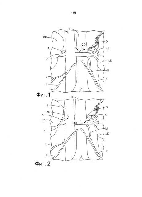 Нервы, подвергающиеся целевой абляции, в нижней полой вене и/или брюшной аорте рядом с ними для лечения гипертензии (патент 2610529)