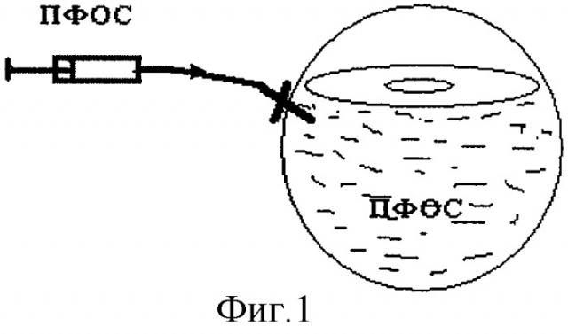 Способ лечения пролиферативной витреоретинопатии (патент 2284812)