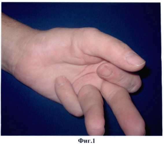 Способ лечения тяжелой формы контрактуры дюпюитрена пальцев кисти (патент 2421168)