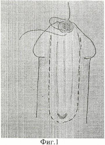 Способ хирургического лечения порока полового члена при эписпадии и экстрофии мочевого пузыря (патент 2429790)