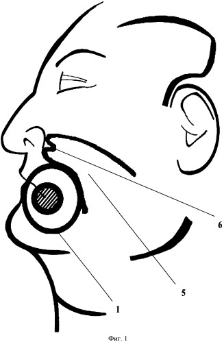 Способ пластики обширного сквозного дефекта мягких тканей щеки, угла рта, фрагментов верхней и нижней губы (патент 2489096)