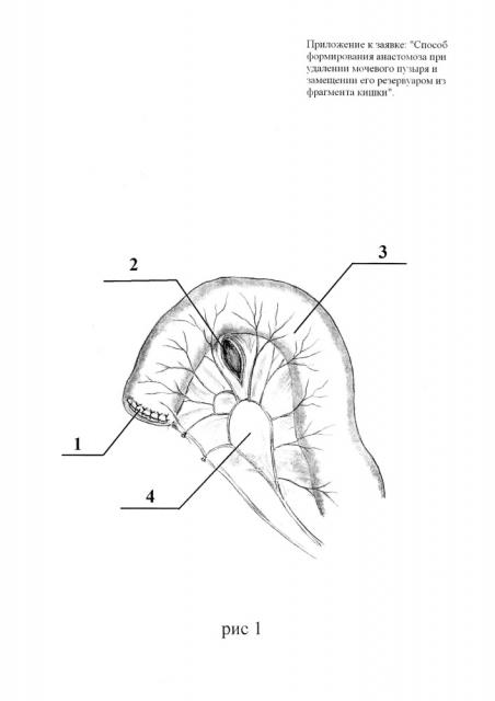 Способ формирования анастомоза при удалении мочевого пузыря и замещении его резервуаром из фрагмента кишки (патент 2624388)