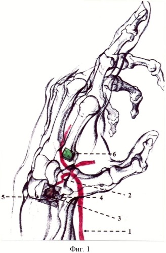 Способ фиксации васкуляризированного костного трансплантата на костях запястья (патент 2489109)