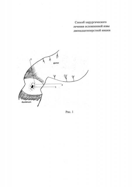 Способ хирургического лечения осложненной язвы двенадцатиперстной кишки (патент 2618649)