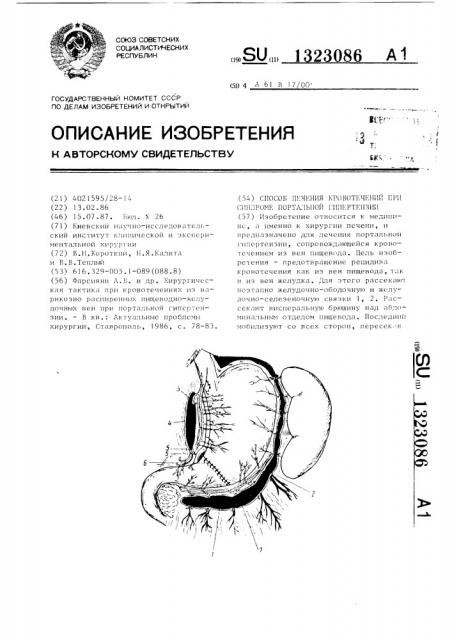 Способ лечения кровотечений при синдроме портальной гипертензии (патент 1323086)
