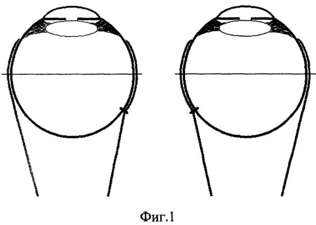 Способ хирургического лечения горизонтального толчкообразного и горизонтального смешанного маятникообразного и толчкообразного нистагма (патент 2269989)