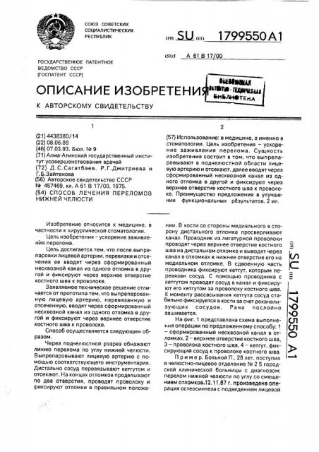 Способ лечения переломов нижней челюсти (патент 1799550)