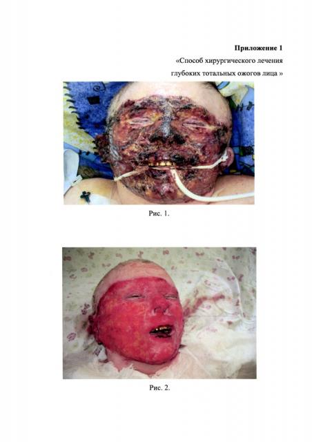 Способ хирургического лечения глубоких тотальных ожогов лица (патент 2632776)