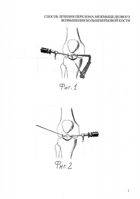 Способ лечения перелома межмыщелкового возвышения большеберцовой кости (патент 2640945)
