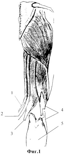Способ хирургического лечения сгибательной контрактуры коленного сустава у детей с дцп (патент 2315577)