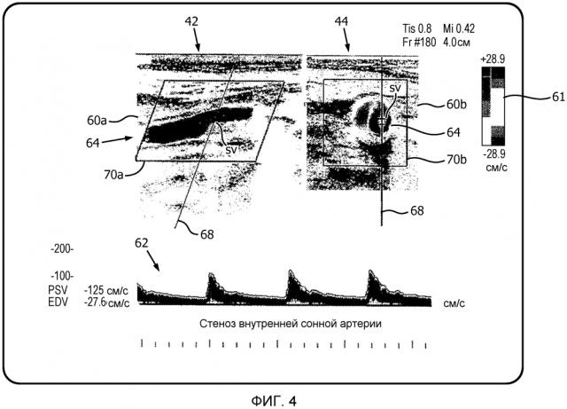 Автоматизированная последовательность операций в двухплоскостном режиме pw для ультразвуковой оценки стеноза (патент 2633915)