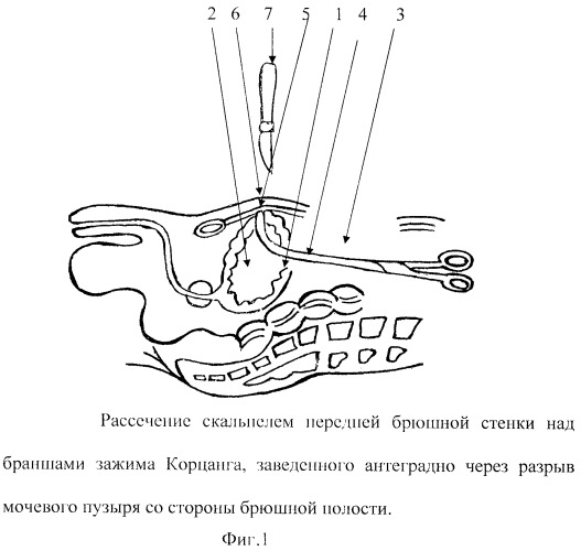 Антеградный способ надлобковой эпицистостомии при внутрибрюшных разрывах мочевого пузыря (патент 2454950)