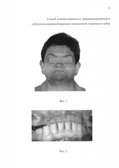 Способ лечения пациентов с декомпенсированной и субкомпенсированной формами повышенной стираемости зубов (варианты) (патент 2615121)