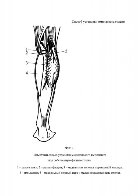 Способ установки имплантата голени (патент 2626267)