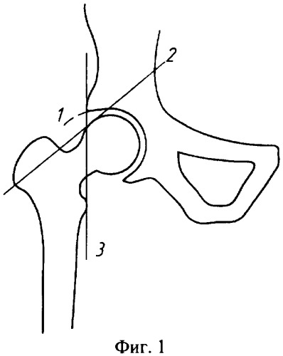 Способ ультразвуковой диагностики ранних стадий остеоартроза тазобедренного сустава (патент 2321350)