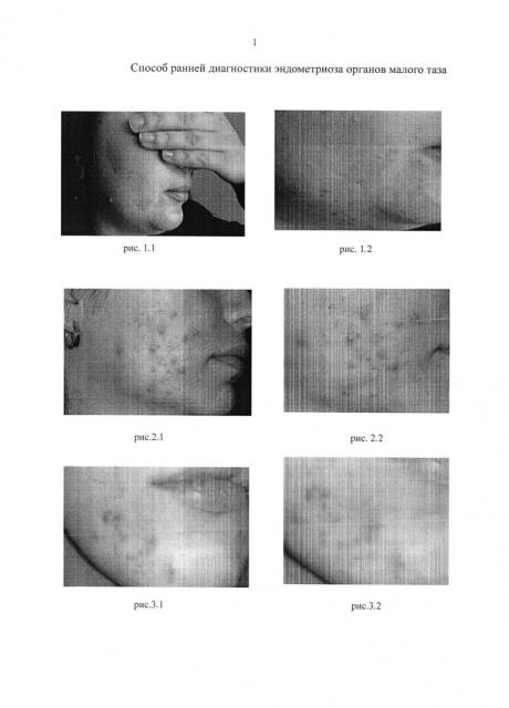Способ ранней диагностики эндометриоза органов малого таза (патент 2616995)
