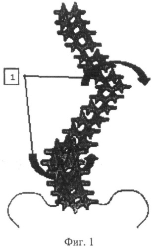 Способ коррекции деформации позвоночника (патент 2506919)