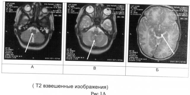 Способ определения зрелости церебральных структур у недоношенных новорожденных (патент 2491888)