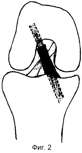 Способ лечения отрывов передней крестообразной связки коленного сустава (патент 2249437)