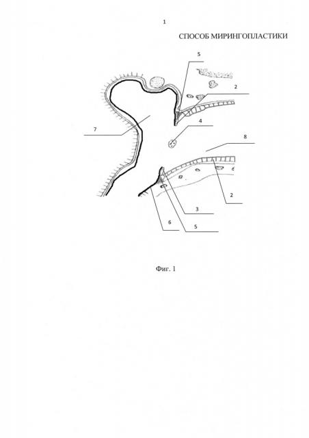 Способ мирингопластики (патент 2649303)