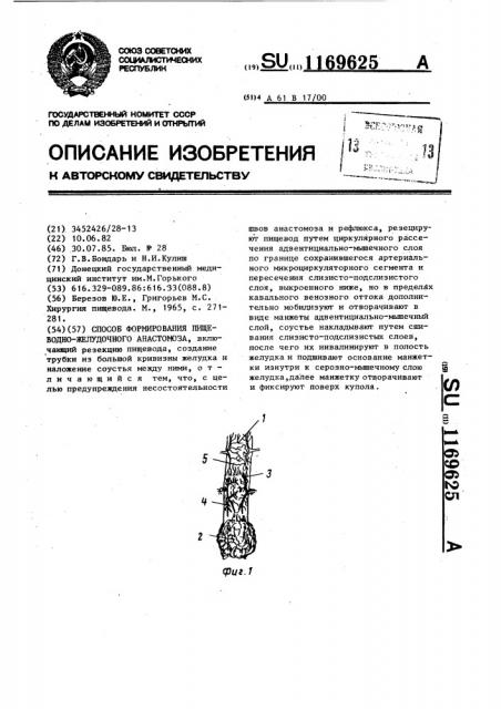 Способ формирования пищеводно-желудочного анастомоза (патент 1169625)