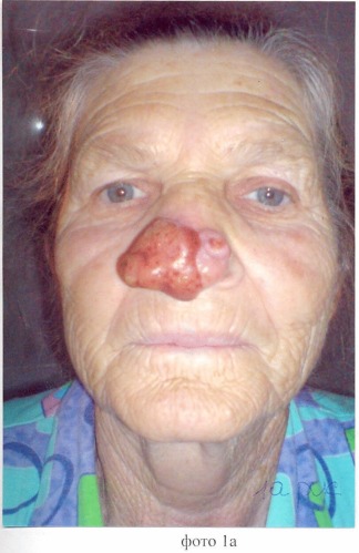 Способ восстановления наружного носа при субтотальных дефектах (патент 2452403)