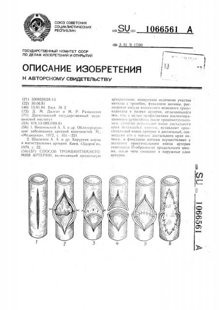 Способ тромбинтимэктомии артерии (патент 1066561)