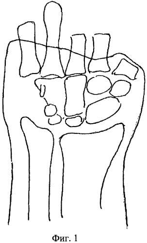 Способ реконструкции первой пястной кости при обширных дефектах мягких тканей культи кисти (патент 2571233)