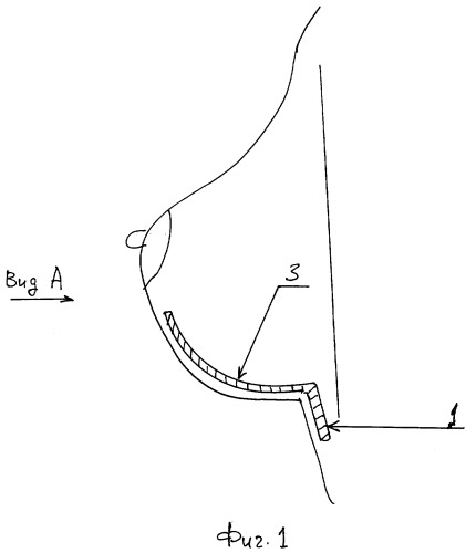 Имплантант для поддержания молочной железы (патент 2332188)